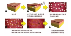 洋格儿Sculptra童颜针