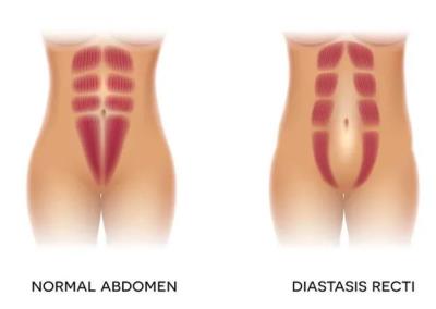 最全的产后腹直肌分离及修复都在这里了～赶紧收藏！